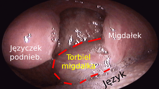 Torbiel lewego migdałka podniebiennego – opis przypadku