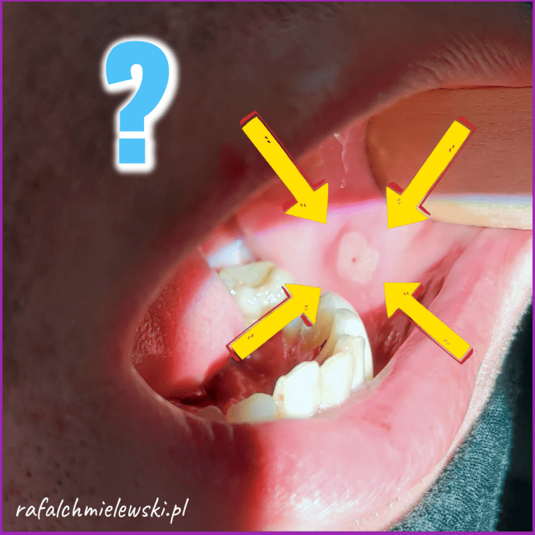 Afta — a dokładnie — nawracające afty jamy ustnej