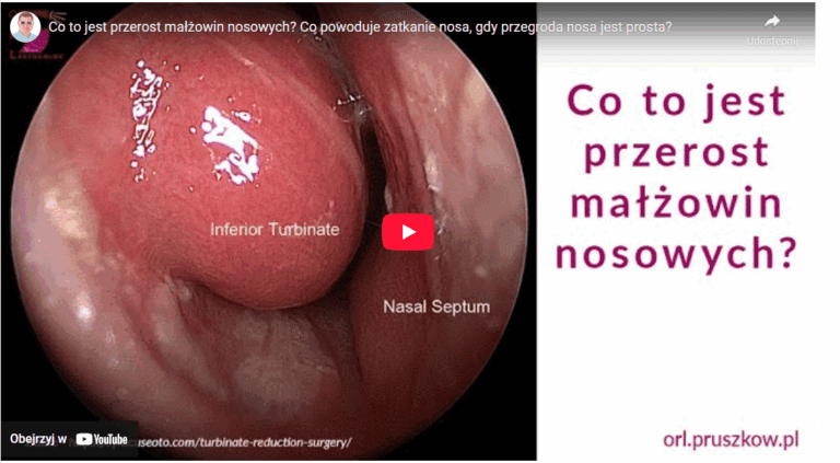 Przerost małżowin nosowych – dlaczego Twój nos nie oddycha mimo prostej przegrody?